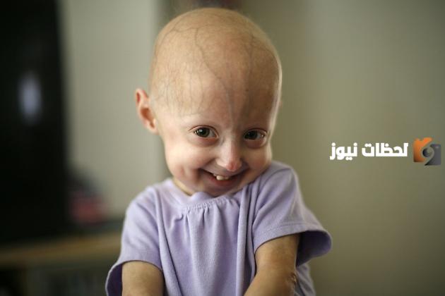 ما هو مرض البروجيريا عند الأطفال؟ | مرض البروجيريا للأطفال