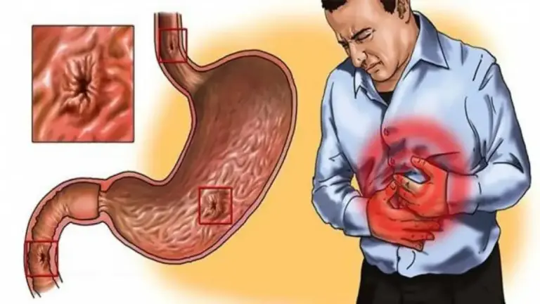 علاج جرثومة المعدة بالأعشاب والقضاء عليها نهائيا من المنزل