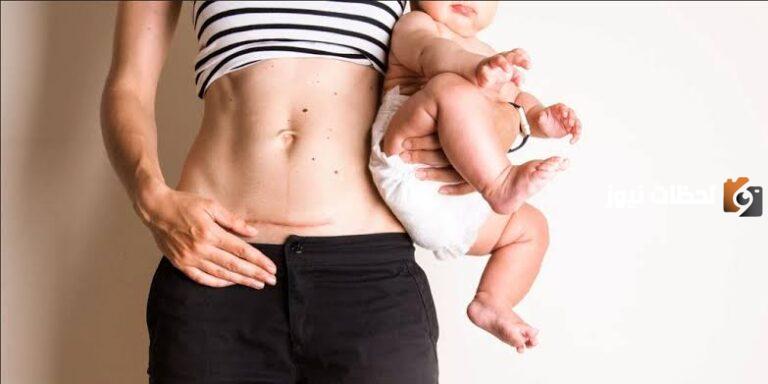 كيف أتخلص من الكرش بعد الولادة القيصرية وما هي أفضل عمليات التجميل المتاحة