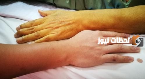 متى تكون نسبة الصفراء خطيرة عند الكبار؟