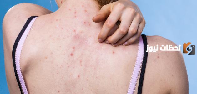تعرف على طرق علاج أثار الحبوب والبقع في المنطقة الحساسة