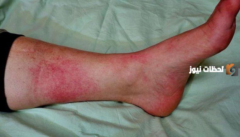 جميع طرق علاج مرض الحمرة بالساق