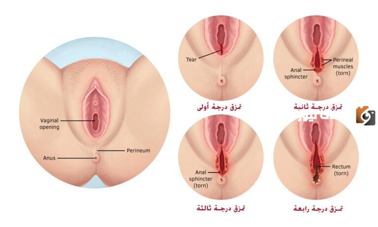 ما هي طريقة تضييق المهبل بعد الولادة