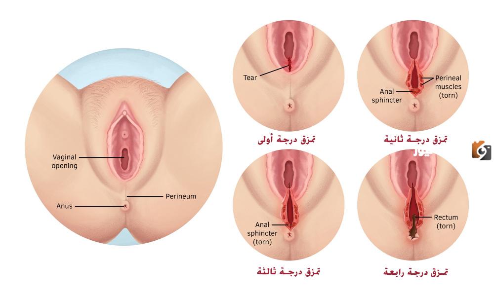 طريقة تضييق المهبل بعد الولادة
