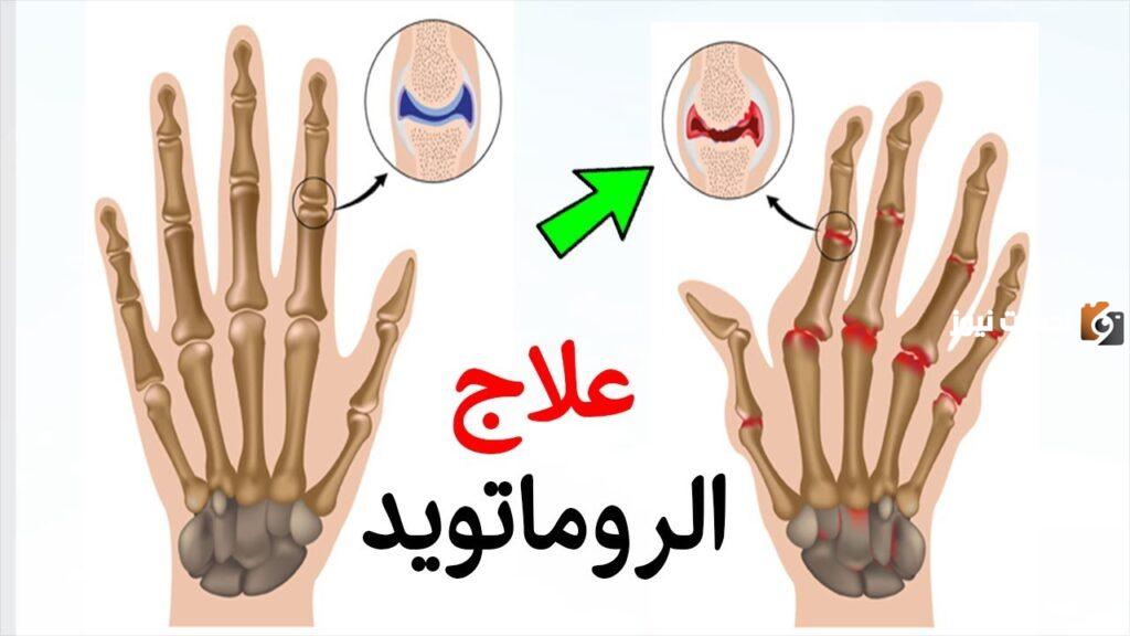 علاج الروماتويد بالاعشاب وقائمة الممنوعات والمسموحات لمرضى الروماتويد