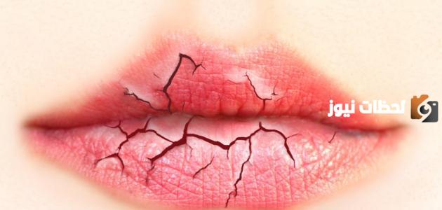 علاج تشقق الشفاه بخلطات طبيعية حديثة (تشققات الشفتين)