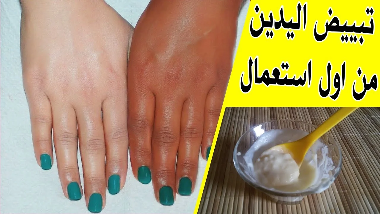 كريم تبييض طبي سريع المفعول لليدين وباقي الجسم