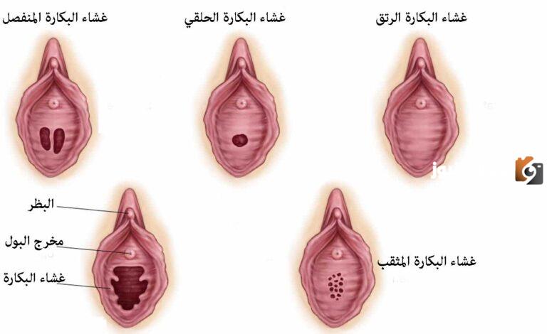 كيف شكل غشاء البكارة السليم و غشاء البكارة المفتوح بالصور
