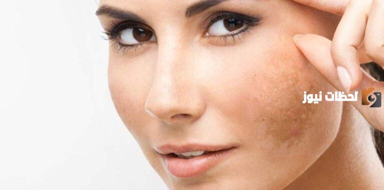 30+ وصفات لعلاج الكلف والنمش