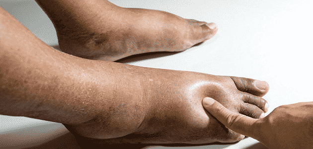 التخلص من الماء الزائد في الجسم في يومين بالأعشاب!! طريقة منزلية مبهرة