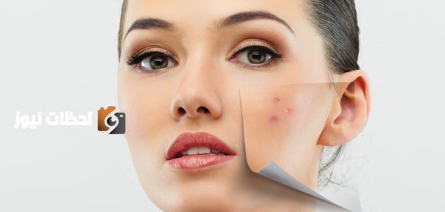حب الشباب وزيادة مخاطر التعرض للاضطرابات الغذائية وتأثيراتها على الصحة