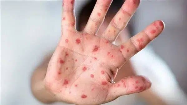 الصحة العالمية توضح ما هو جديد بشأن لقاح جدري القرود